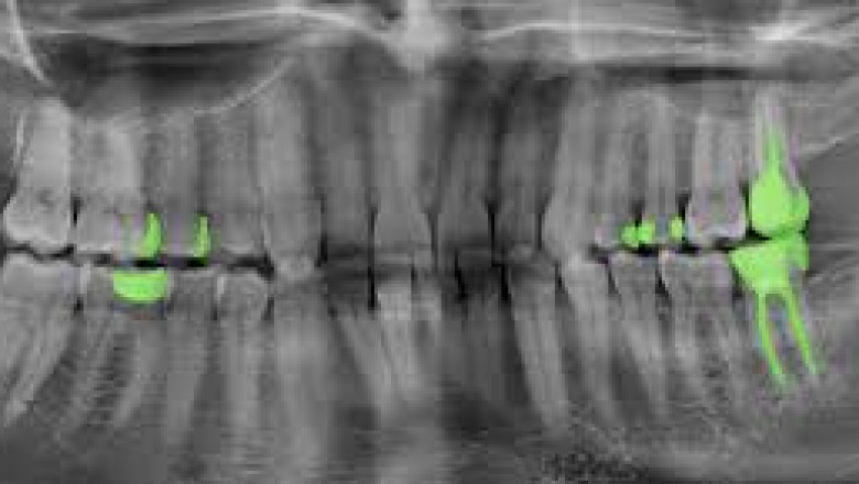 Dental Imaging Market