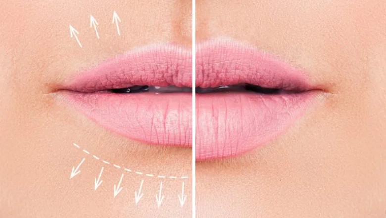 How Can Women Achieve Natural-Looking Fullness with Laser Treatment for Lips?