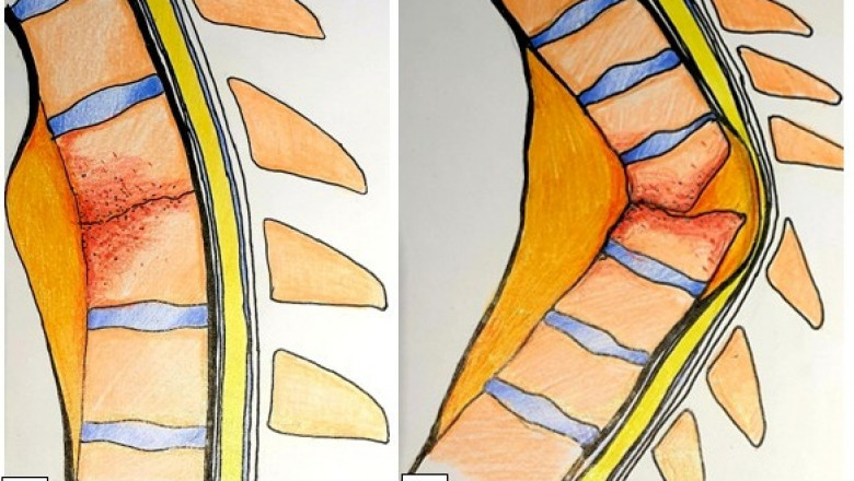 Slip Disc: Causes, Symptoms, and Treatment Options