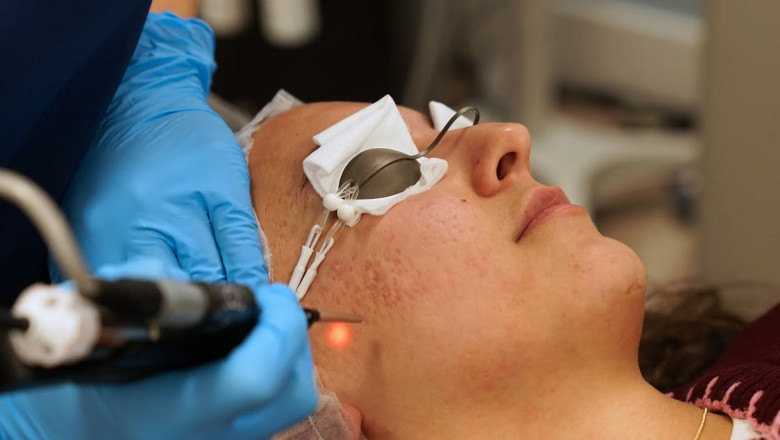 Aesthetic Lasers and Energy Device Market Growth, Share, Opportunities & Competitive Analysis, 2024 – 2032