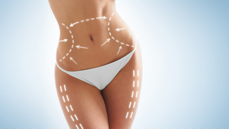 شفط الدهون في الرياض من قبل خبراء التجميل