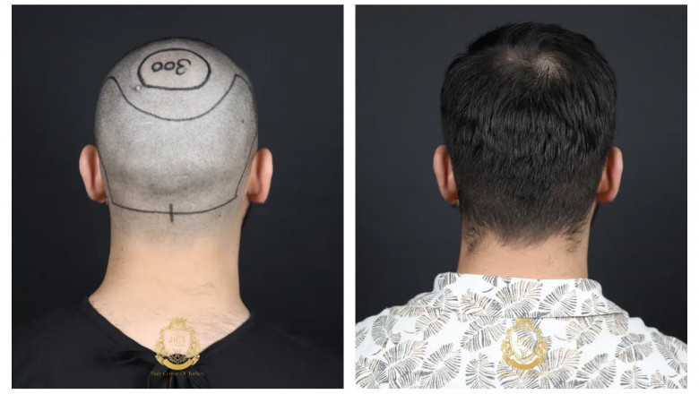 6 Common Myths About Hair Transplant Scars