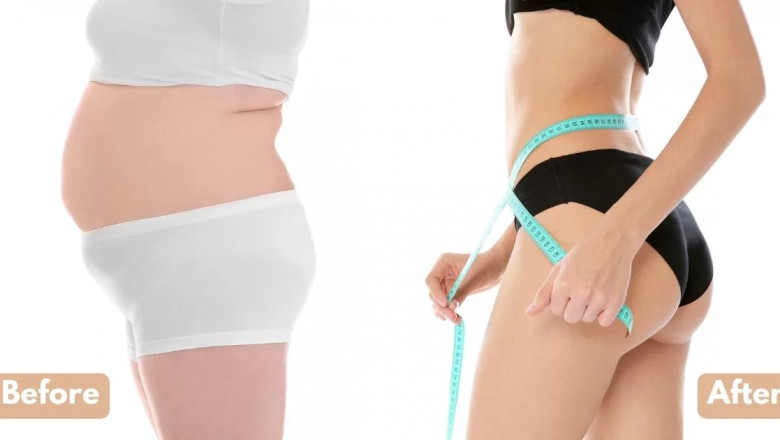Best Butt Fat Transfer Surgeon in Dubai: What to Expect Before and After Surgery