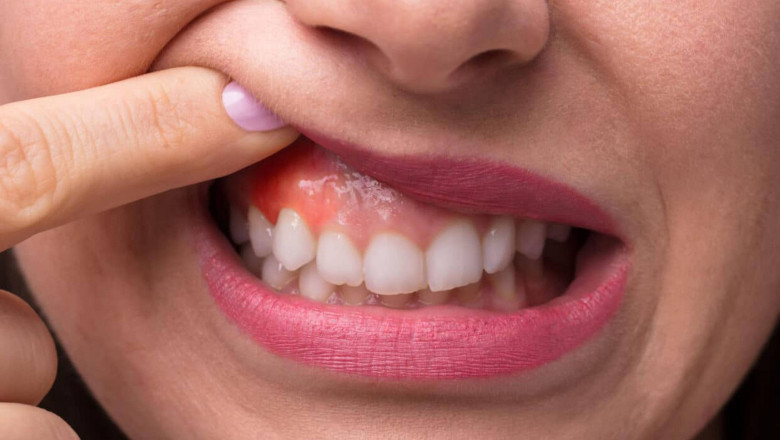 Gingival Recession Market to Flourish at a Significant Pace Owing to Growing Rates of Periodontal Diseases