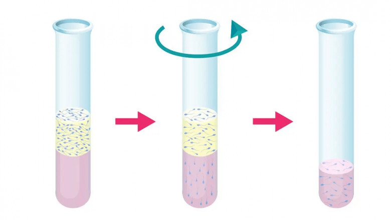 How Double Density Gradient Centrifugation Impacts Sperm Quality
