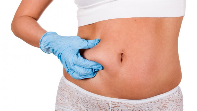 Best Diet & Exercise Tips After Liposuction in Riyadh