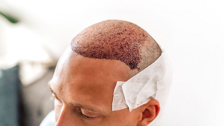 Hair Transplant in Riyadh: Is It Painful? Here’s the Truth