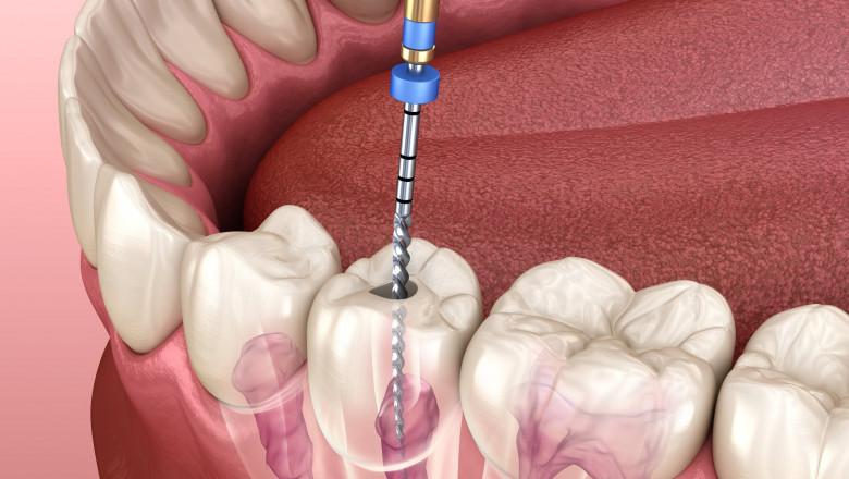 Root Canal Cost: Factors, Pricing, and Ways to Save