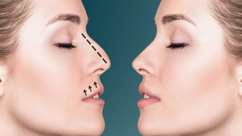 كيف تحصل على أفضل نتائج تجميل الأنف في الرياض؟