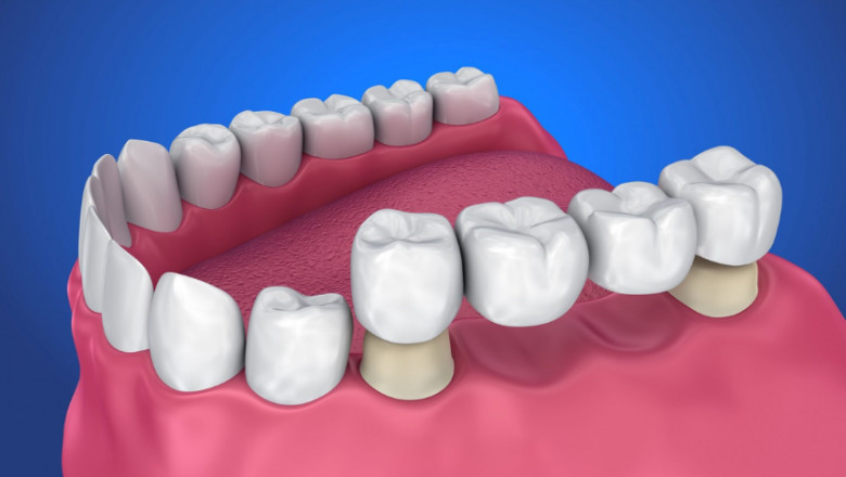 What Happens if You Don't Replace a Missing Tooth? Bridges Can Help.
