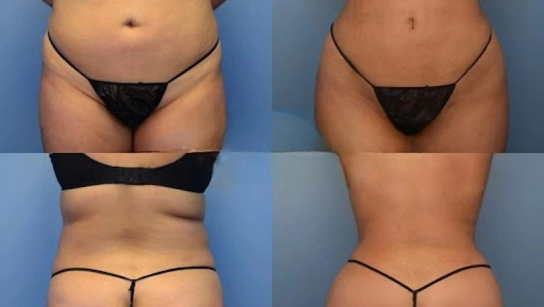 How to Find the Best Fat Transfer Surgeon in Dubai for Natural Results