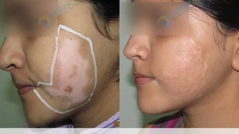 Vitiligo Treatment in Delhi: How Phototherapy is Transforming Vitiligo Care