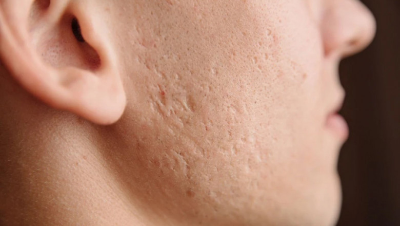 Anti-Acne Dermal Patch Market: Rising Demand, Key Drivers, Challenges, and Future Growth in the Skincare Sector