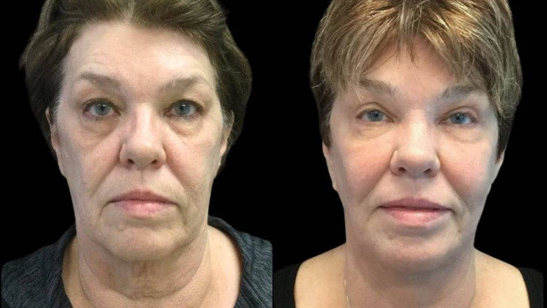 Get the Best Value for Fractional CO2 Laser Treatment with These Tips