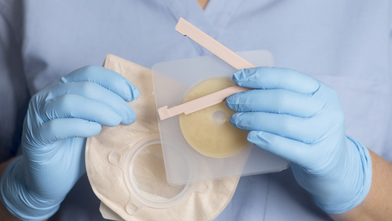 Ostomy Devices Market Forecast Indicates Significant Revenue Surge Fueled by Rising Chronic Disease Prevalence
