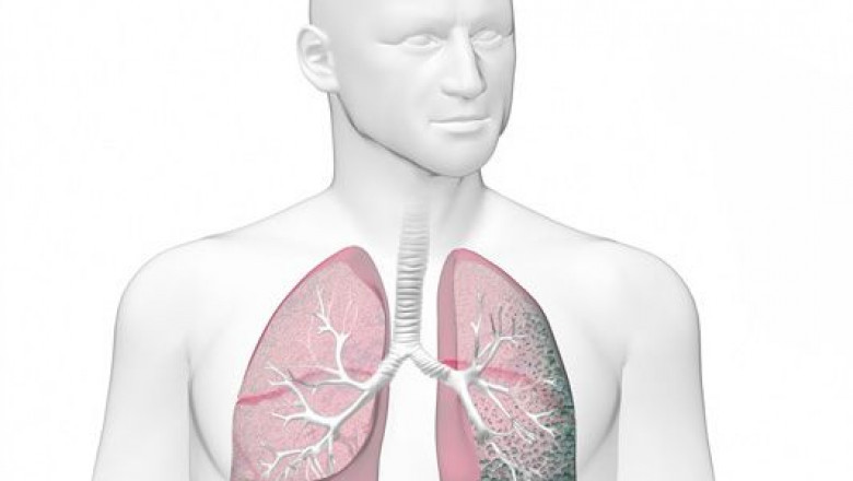 Emphysema Market Expansion Driven by Advanced Treatment Options and Rising COPD Cases
