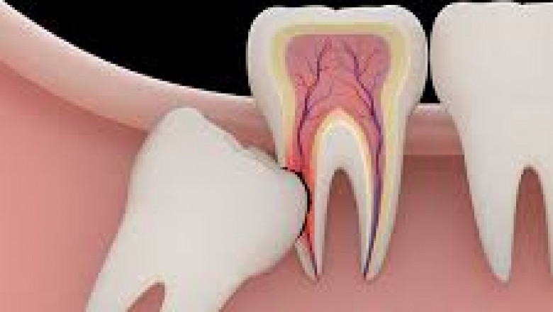 What Happens if You Delay Tooth Extraction in Dubai?