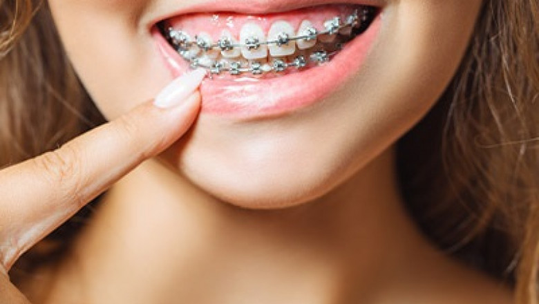 What to Expect After Getting Braces in Dubai