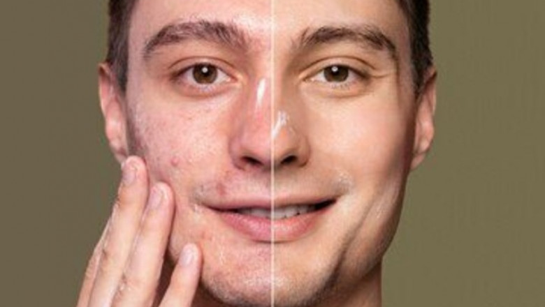 CO2 Laser Resurfacing: Benefits, Risks, and What to Expect in Norwich!