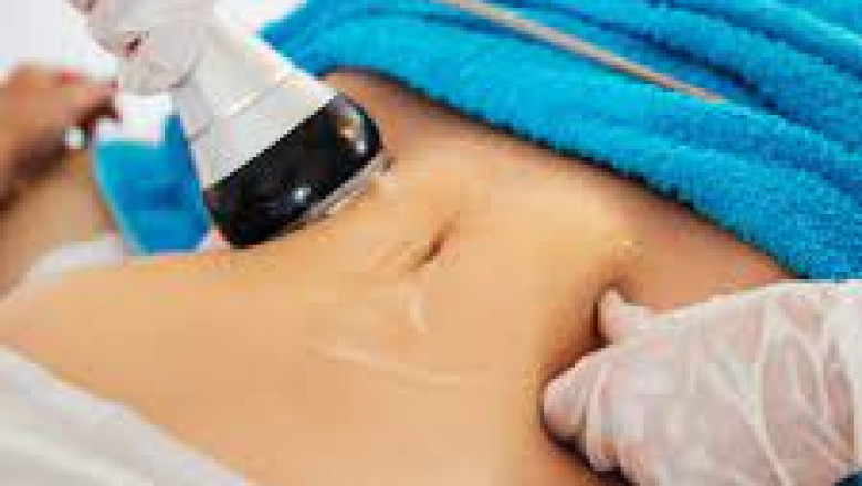 Discover CoolSculpting, Freeze Fat for a Leaner Look