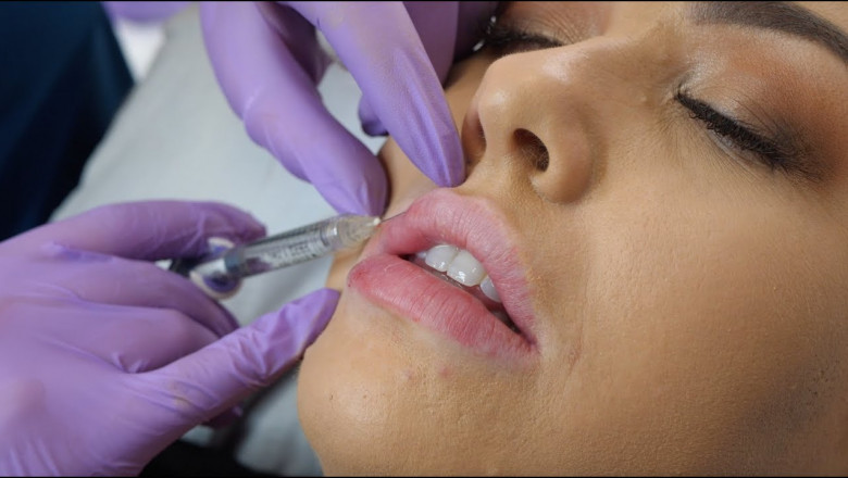 Long-Lasting Lip Filler Injections: How to Extend the Effects