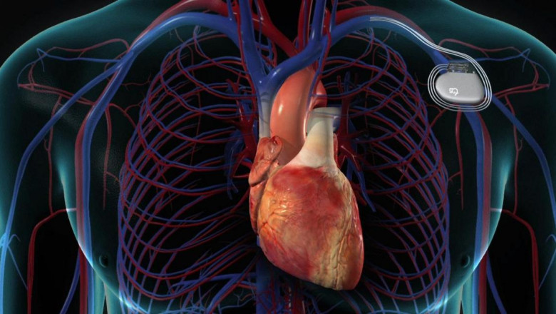 Expert Pacemaker Surgery in UAE: Trusted by Thousands of Heart Patients