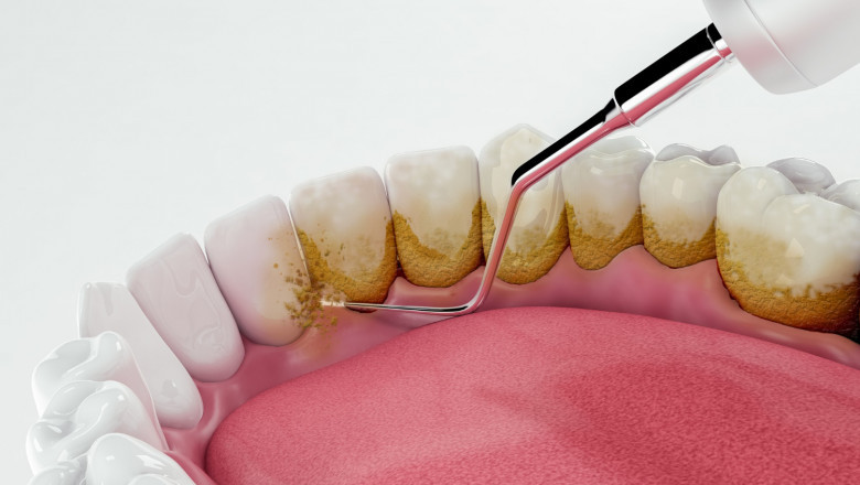 Souriez avec confiance grâce à Invisalign Montréal : La solution discrète pour redresser vos dents