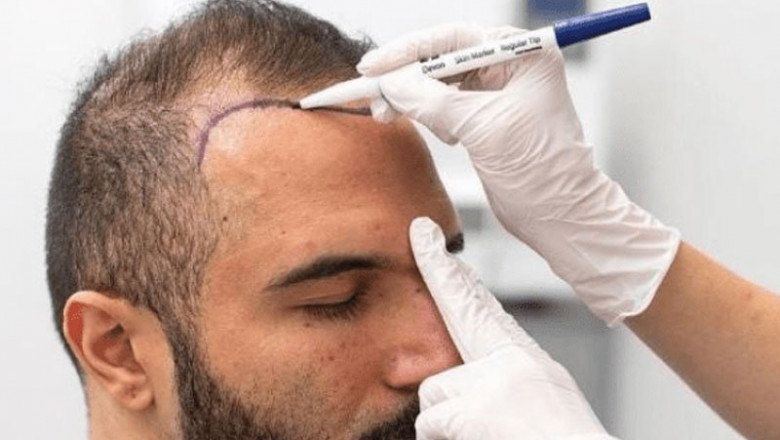 Get to Know the Latest Trends in Hair Transplantation in Dubai