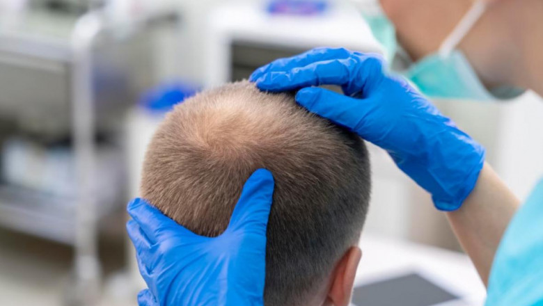 How Does A Hair Transplant Work?