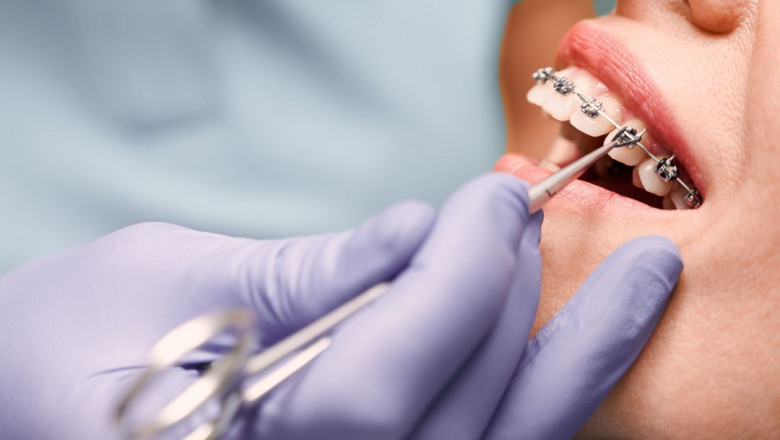How Much Does an Orthodontist Charge for Braces? Full Cost Breakdown