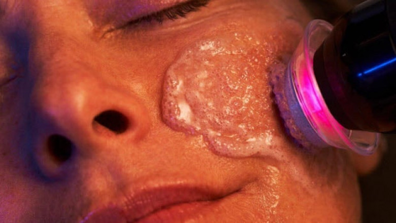 Moxi Laser Treatment | Skin Rejuvenation for a Youthful Glow