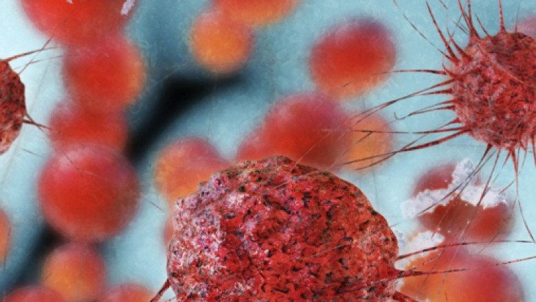 Pancreatic Cancer Precision Medicine Market Size, Share & Trends Report