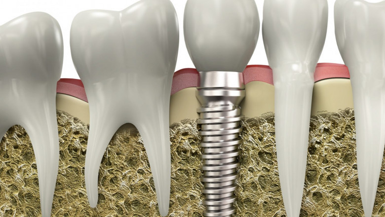 Save Your Smile with Root Canal Therapy in SW Calgary