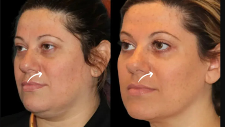 Best Aesthetic Clinic in Dubai for Sculptra Fillers and Inclusive Treatments
