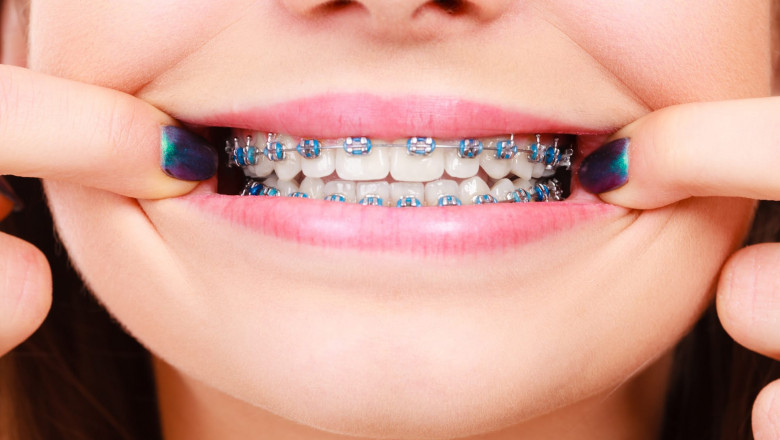 Fixing Gaps & Crowded Teeth – Braces Options in Dubai