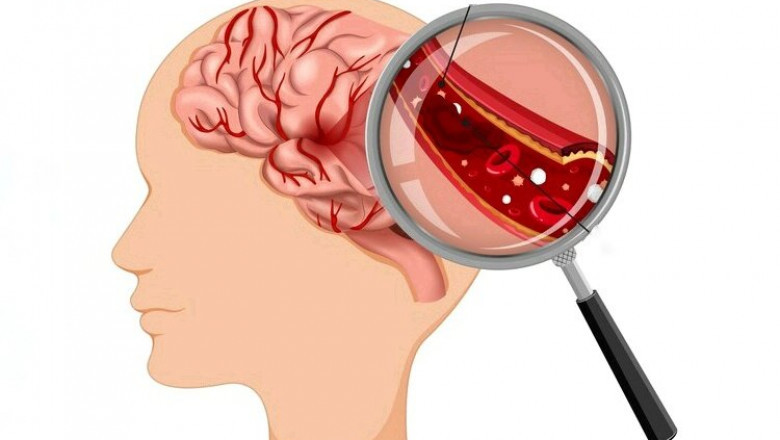 Intracranial Hemorrhage Diagnosis Market Set to Soar Due to Rising Incidence of Brain Injuries