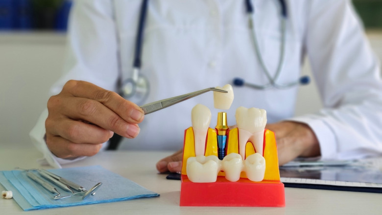 The Complete Guide to Dental Implants from a Trusted Dentist in Saskatoon