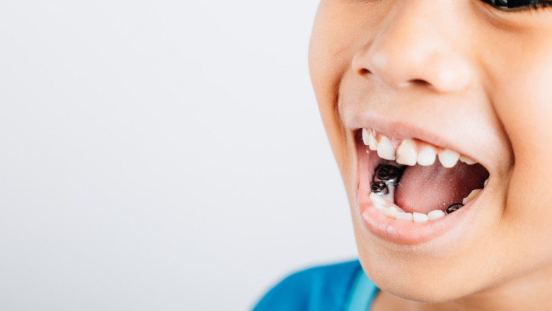 Why Choose Pediatric Stainless Steel Crowns in South Miami?