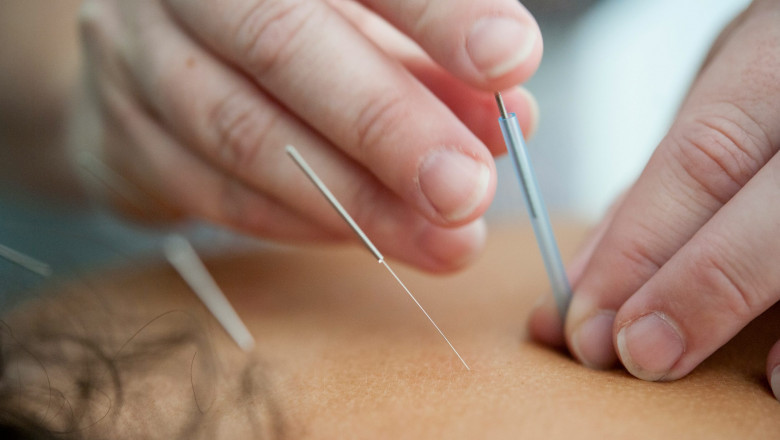 Acupuncture at Evolve: A Way to Restore Balance and Alleviate Health Concerns