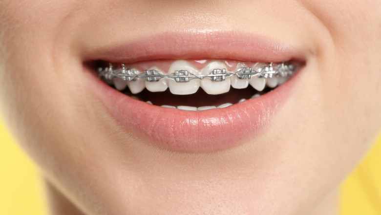 How Braces Can Improve Your Smile and Oral Health