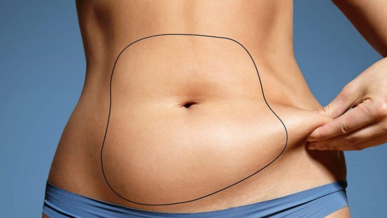 The Complete Path Liposuction Surgery and Recovery in Dubai