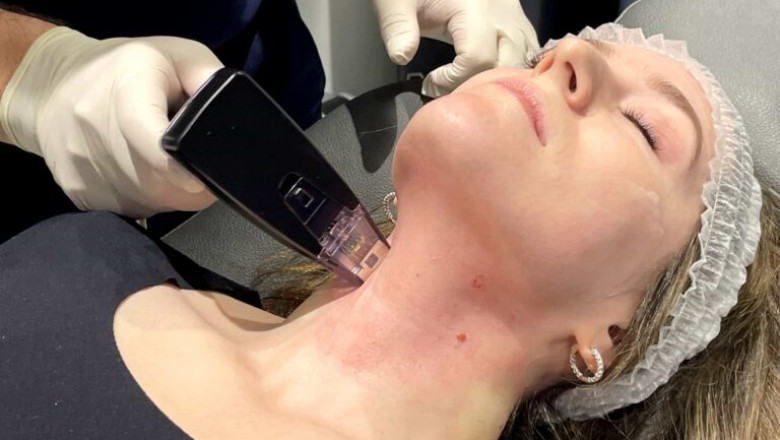 Restore Skin Tightness and Texture with Morpheus8 Treatment!