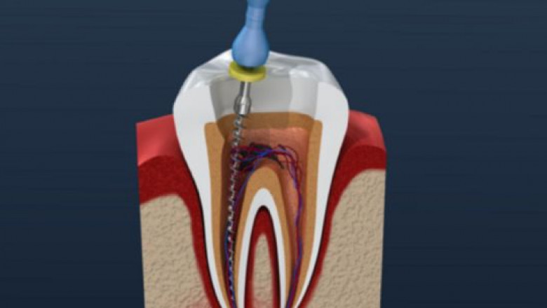 Restore Your Smile with Expert Root Canal Treatment in Sidney