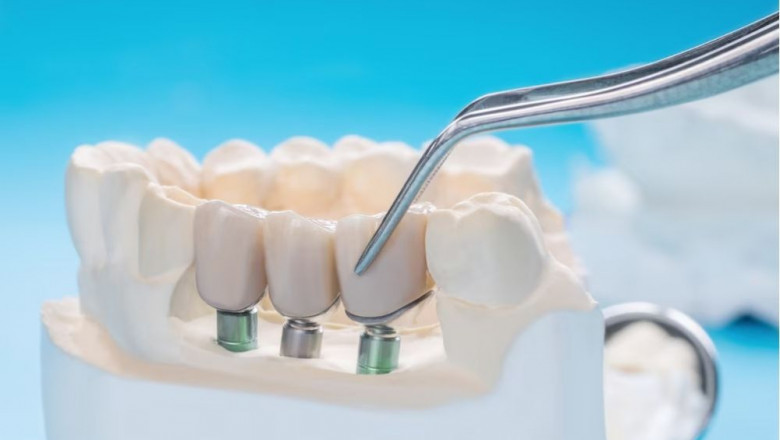 How to Care for Your Dental Implants for Long-Term Success