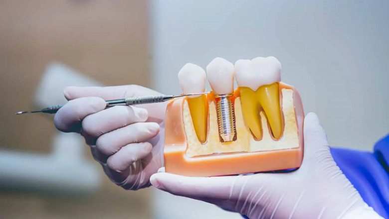 Restoring Smiles: Dental Implants & Family Dentistry In New Bern