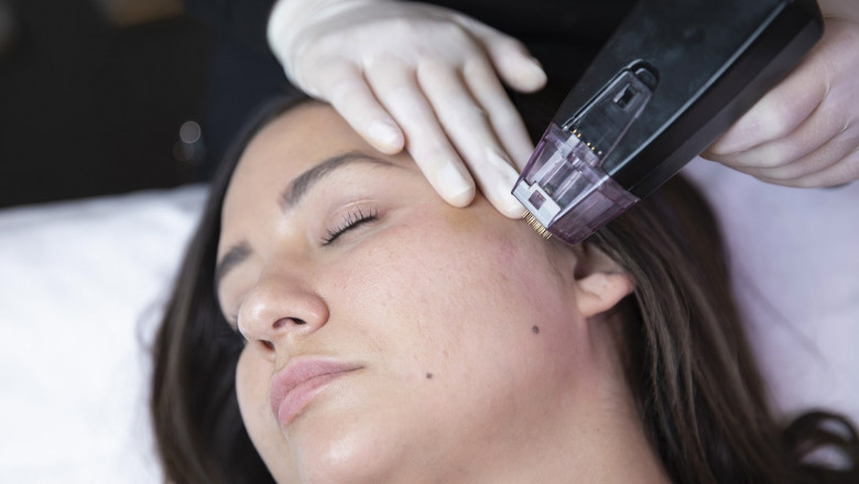 Your No-Downtime Skin Snatch — Morpheus8 Treatment