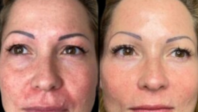 Invite Radiance with Profhilo Treatment in Dubai