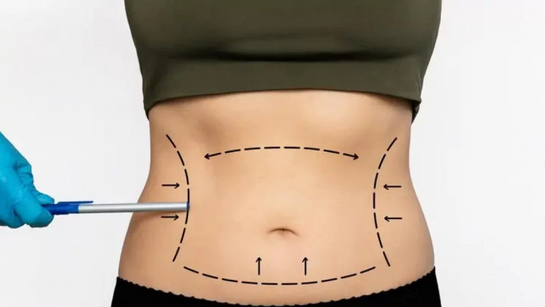Snatch Your Figure and Drop Inches with Liposuction
