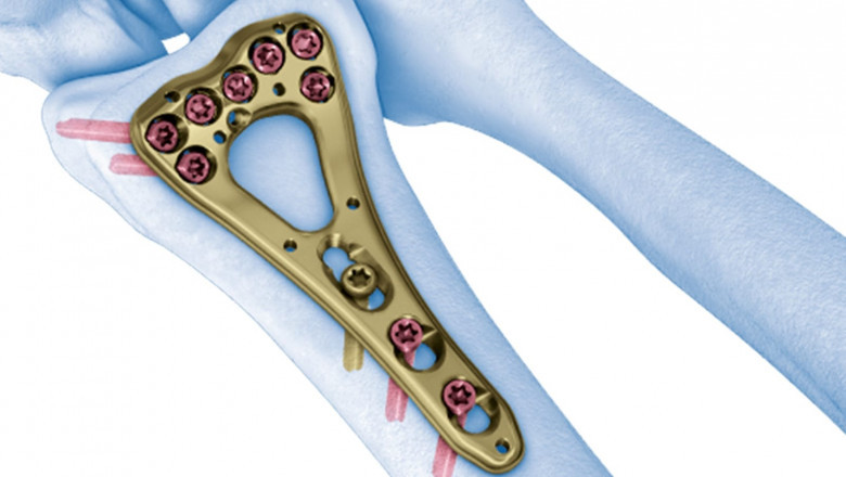 Bone Fixation Plates Market Analysis: Leading Companies and Competitive Landscape