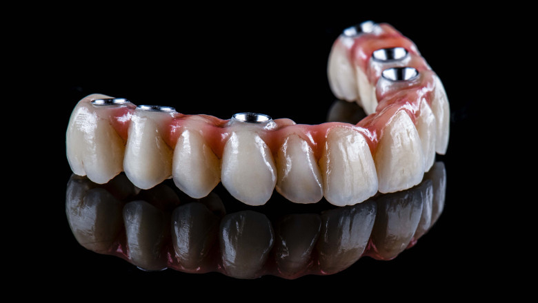 Why Full Mouth Dental Implants May Be Your Solution